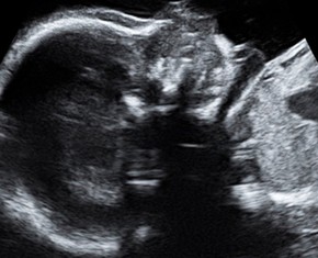 When Pregnancy Goes Wrong