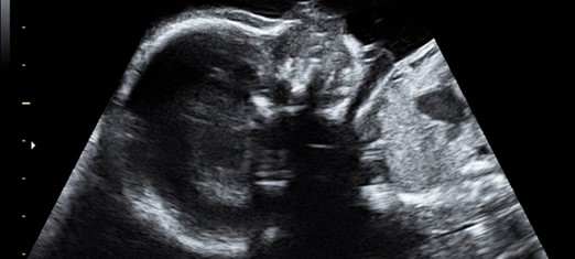 When Pregnancy Goes Wrong