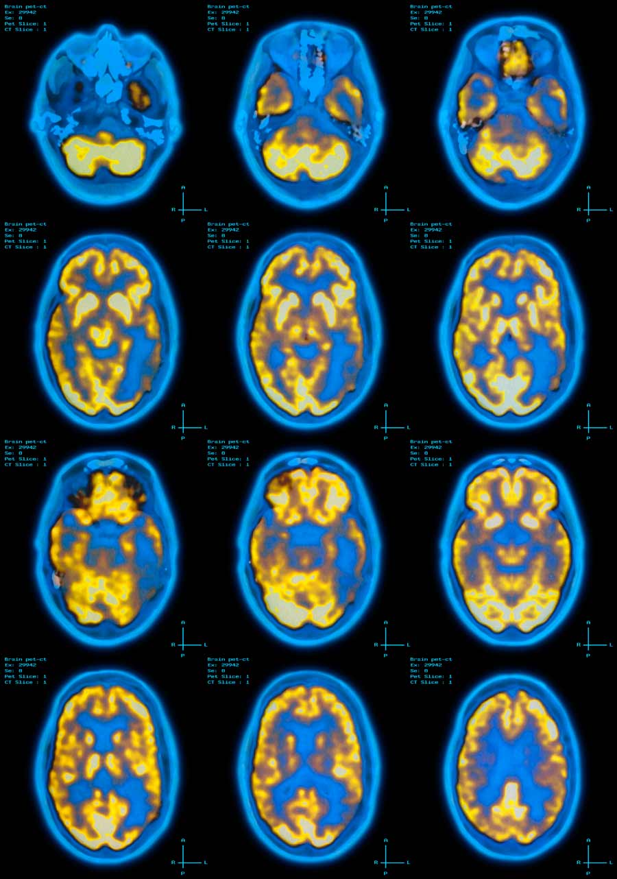 pet-scans